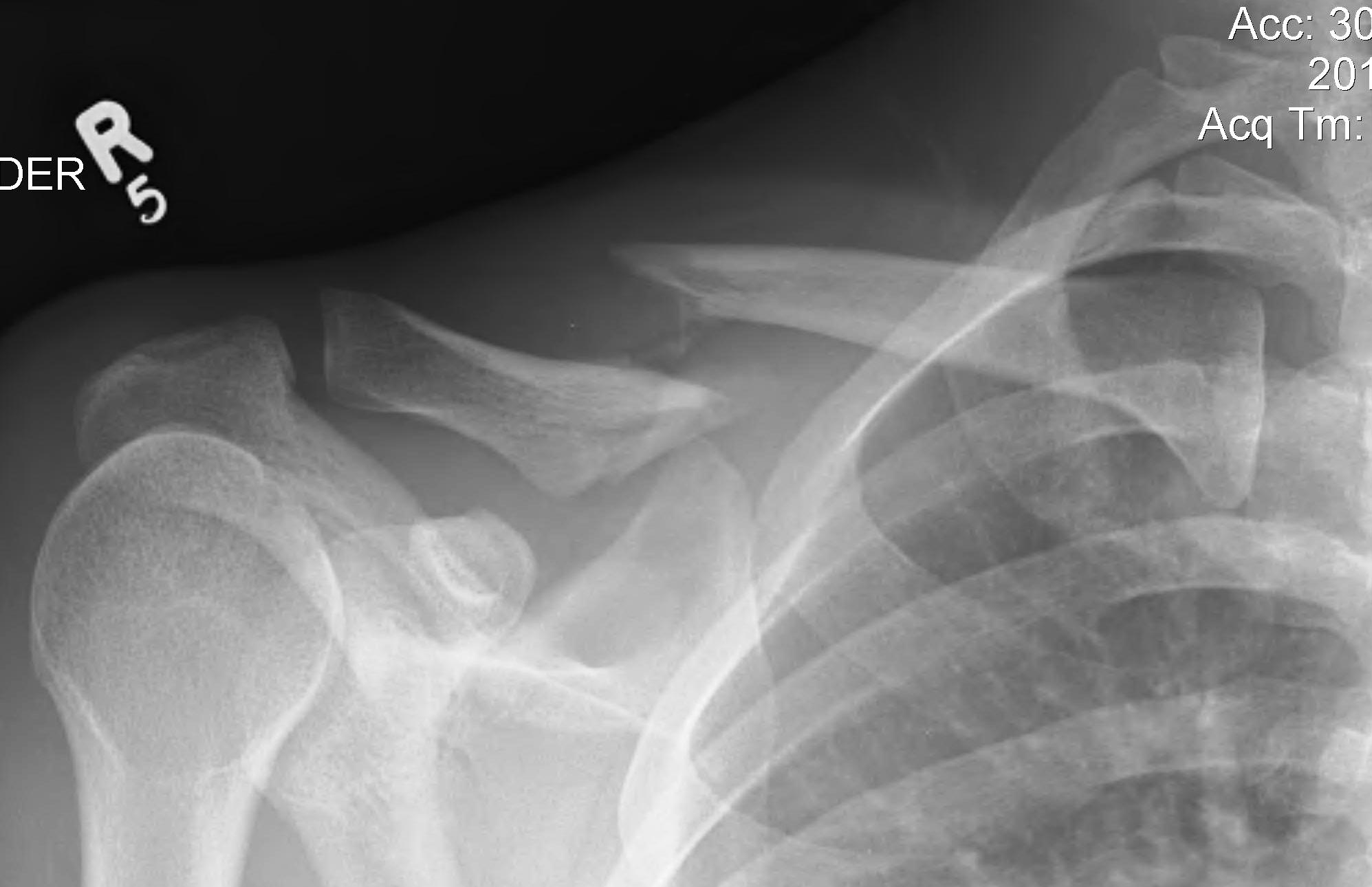 Clavicle Midshaft Displaced